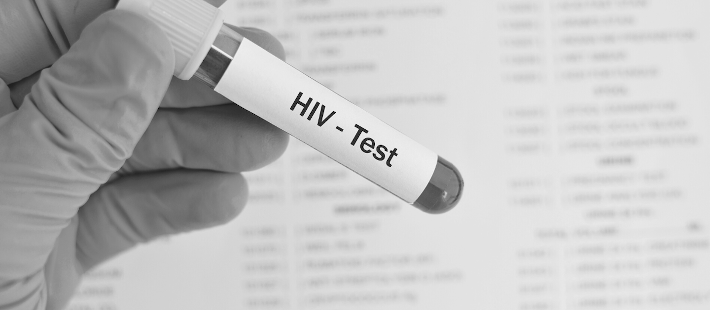 Nemocný banán pozná každý. HIV ale vidět není, testuj se včas